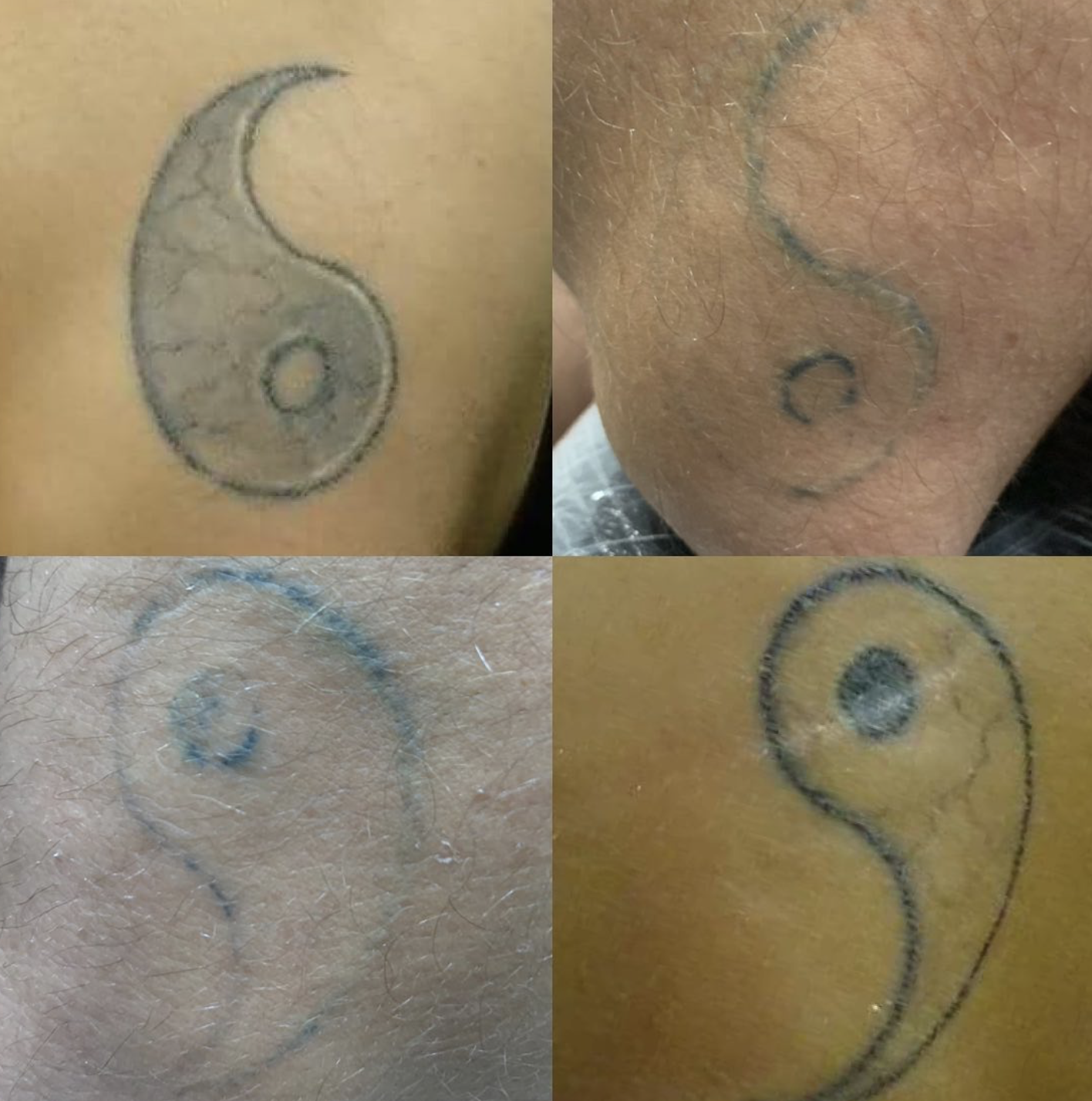 Cuarta imagen de proceso real de eliminacion laser