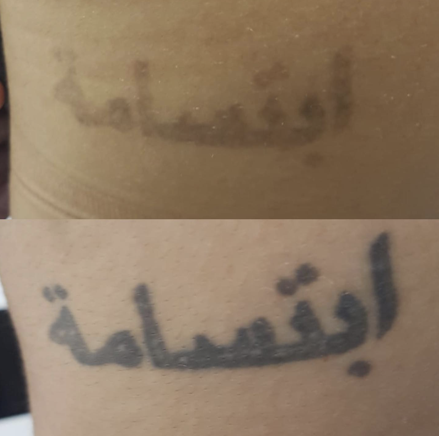 Antes y despues de eliminacion de tatuaje